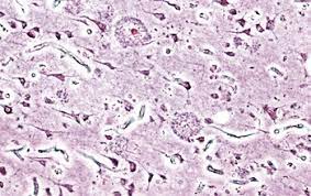 Alzheimers Disease Through Microscopy 1 Microscopia innovativa illumina il metabolismo dei lipidi nell'Alzheimer